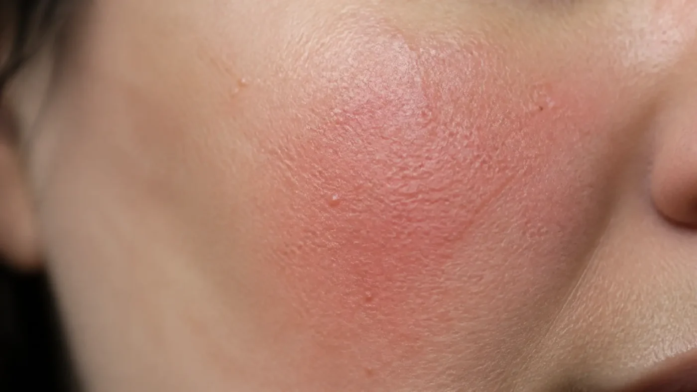Macro close-up of skin showing patchy redness and bumps typical of allergic contact dermatitis
