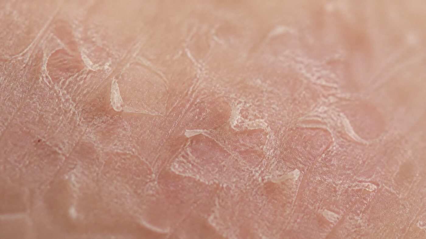 Macro close-up of dehydrated, damaged skin texture with dryness and micro-cracks